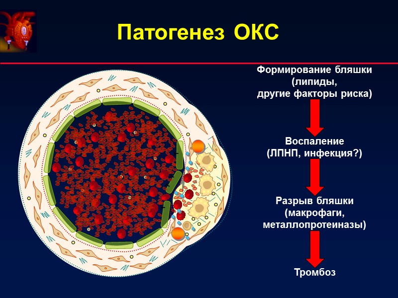 Патогенез ОКС  Формирование бляшки (липиды,  другие факторы риска)    Воспаление